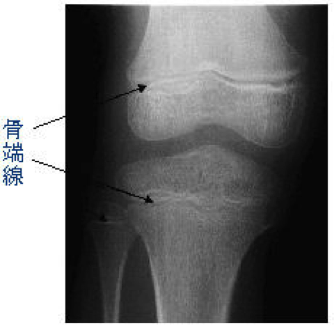 発育期の骨の成長